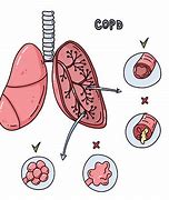 Image result for Best Treatment for COPD Illustration