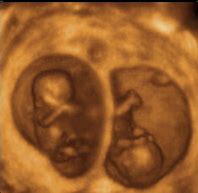 Image result for 11 Week Ultrasound Twins