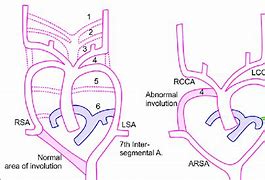 Image result for Retrocaval Artery