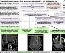 Image result for IRM Cerebrale