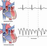 Image result for Ventricular Fibrillation Symptom