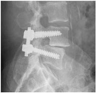 Image result for Lumbosacral Fusion