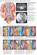 Image result for Retrocaval Ureter vs Normal