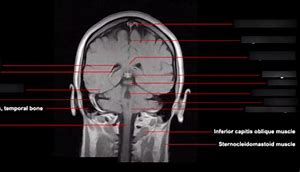 Image result for Mid Coronal Plane