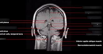 Image result for Coronal Plane Brain MRI