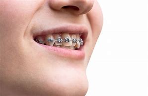 Image result for Fixed Braces Teeth Side View