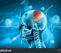 Image result for Brain Cancer Photo Human