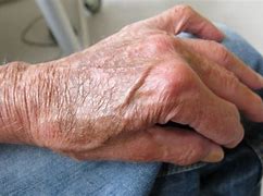 Image result for Sclerotic Atrophy of Skin