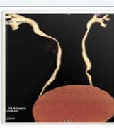 Image result for J-shaped Ureter