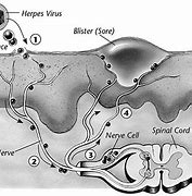 Image result for Herpes Genitalis