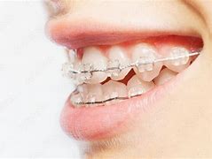 Image result for Fixed Braces Teeth Side View