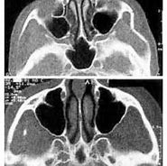 Image result for Zygomatic Arch Fracture CT