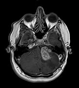 Image result for Vestibular Schwannoma Gross Pathology