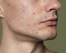 Image result for Acne Scars Men