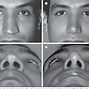 Image result for Nasal Alar Groove