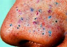 Image result for Bad Blackheads