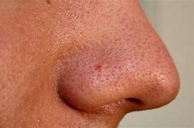 Image result for Pustules On Nose