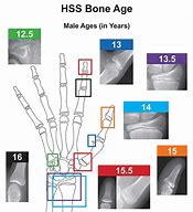 Image result for Bone Age Hand X-ray