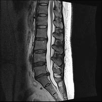 Image result for MRI Scan Lower Back