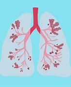 Image result for COPD Pinterest