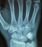 Image result for Capitate Bone Fracture