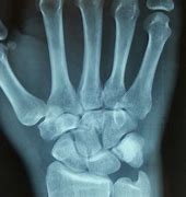 Image result for Capitate Bone Fracture Repair