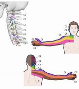 Image result for Nerve Neck Shoulder Pain