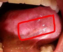 Image result for Blood Spots Under Tongue