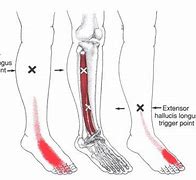 Image result for Extensor Digitorum Foot Pain