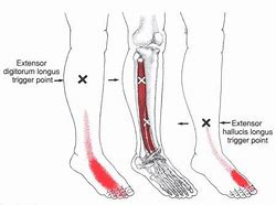 Image result for Extensor Digitorum Longus Foot Pain