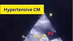 How Hypertension Affects Your Heart Muscles? Concentric Cardiac Hypertrophy on Echo! #hypertension