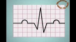 Understanding ECGs ( EKG )