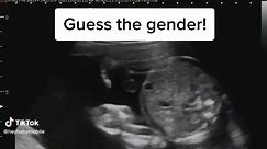 Ultrasound Gender Prediction: Boy or Girl?