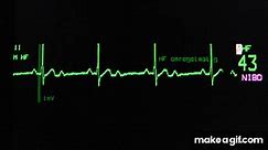 sinus rhythm, second degree AV block, 2:1 block on an ECG heart monitor on Make a GIF