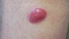 Merkel Cell Carcinoma Warning Signs and Images