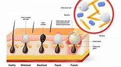 Chest Acne Treatment - Dr. Michele Green M.D.