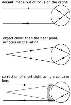 the eye - short sight