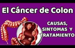 EL CÁNCER DE COLON, Causas, signos y síntomas, diagnóstico y tratamiento